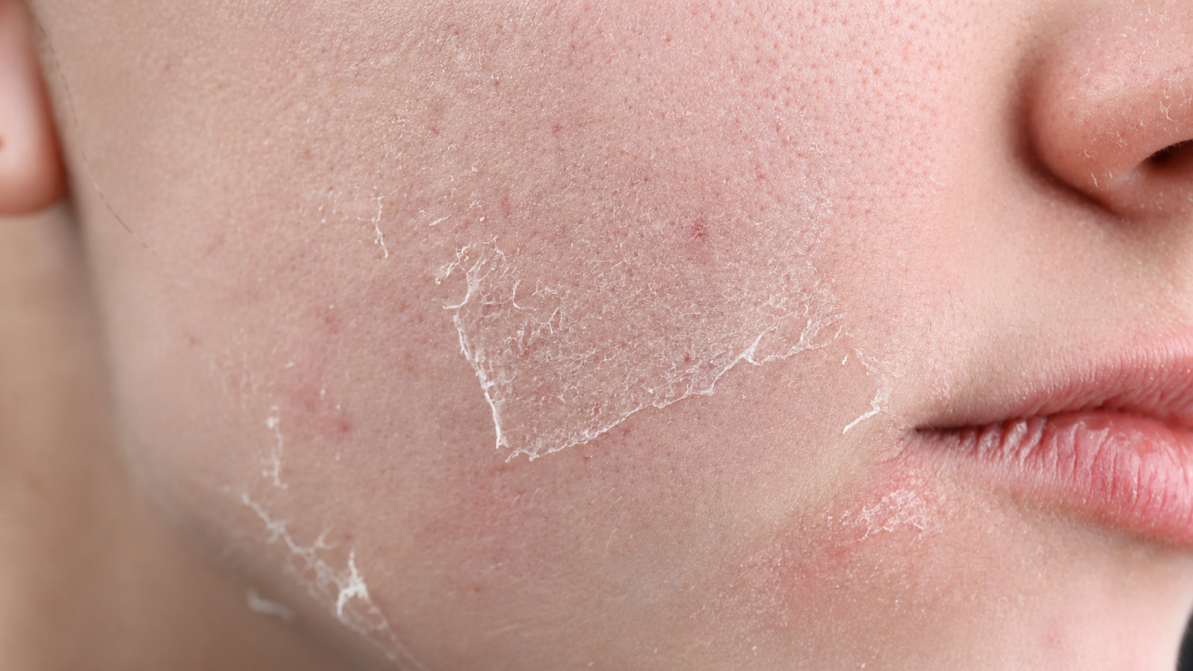 Why Your Skin Looks Tired: 9 Hidden Causes &Amp; Quick Fixes 9 Close-Up Of A Person’s Cheek And Lips Showing Dry, Flaky Skin With Visible Peeling Patches And Uneven Texture, Highlighting Dead Skin Buildup And Dehydration.